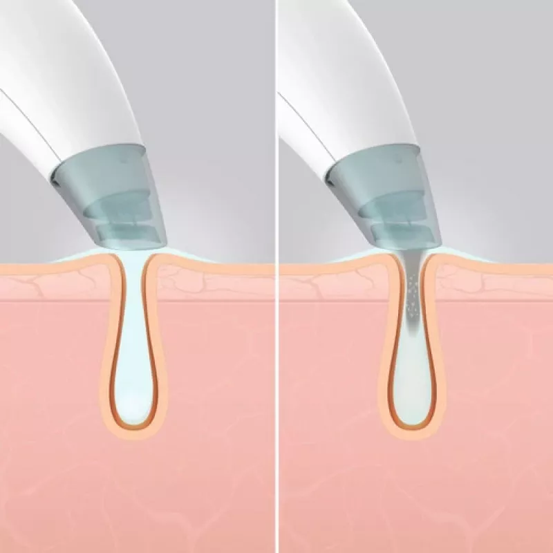 Dispositivo per la cura della pelle HoMedics FAC-HY100 idradermabrasione detergente trasparente, bianco